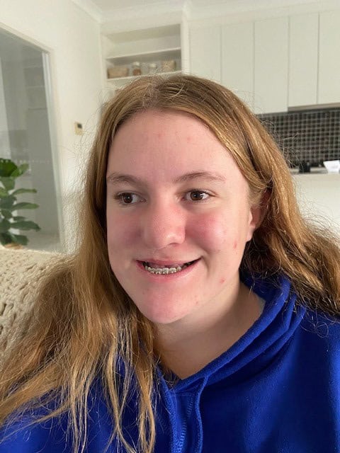 Young woman who was born with cleft lip and palate