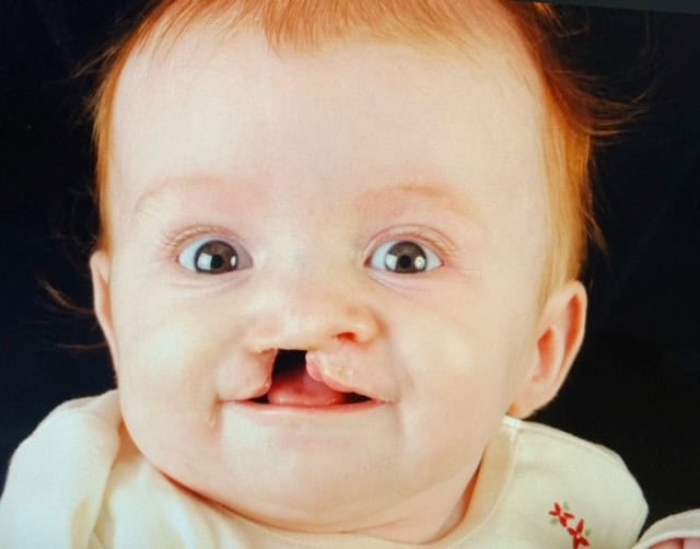 Baby with cleft lip and palate before surgery