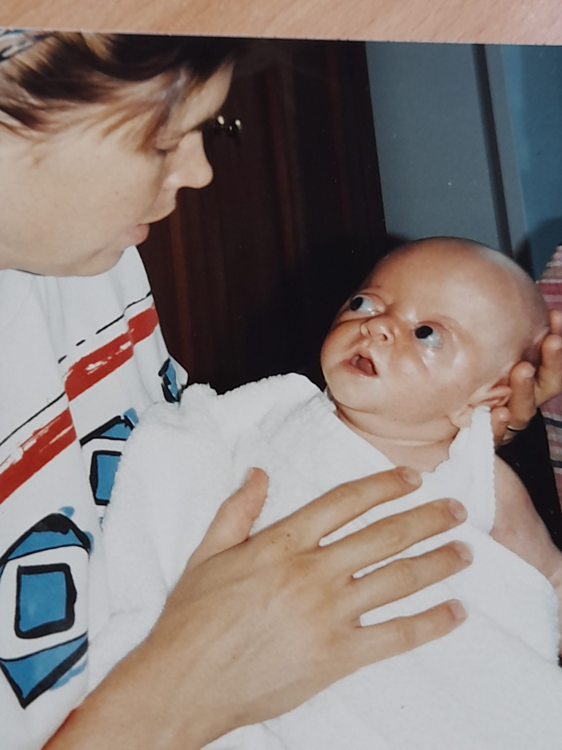 Baby with Apert syndrome held by mother