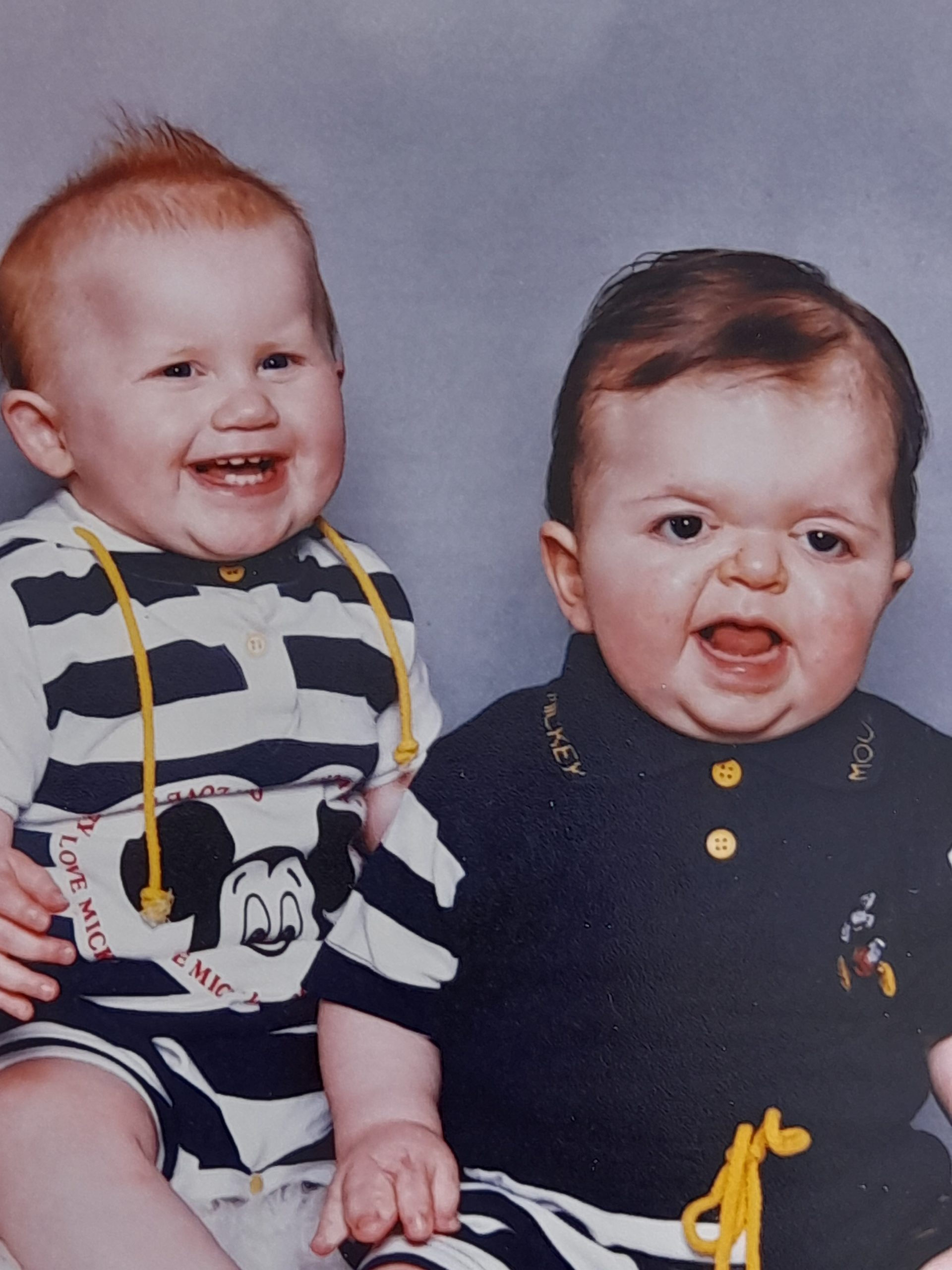 Little boy with Apert syndrome sitting next to sibling