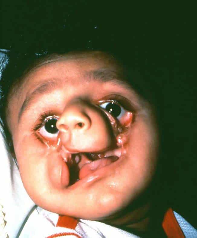 Boy who was born with a complex craniofacial cleft at birth