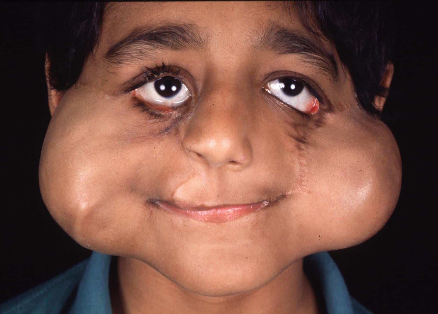 Boy who was born with a complex craniofacial cleft in the process of his surgical treatment journey