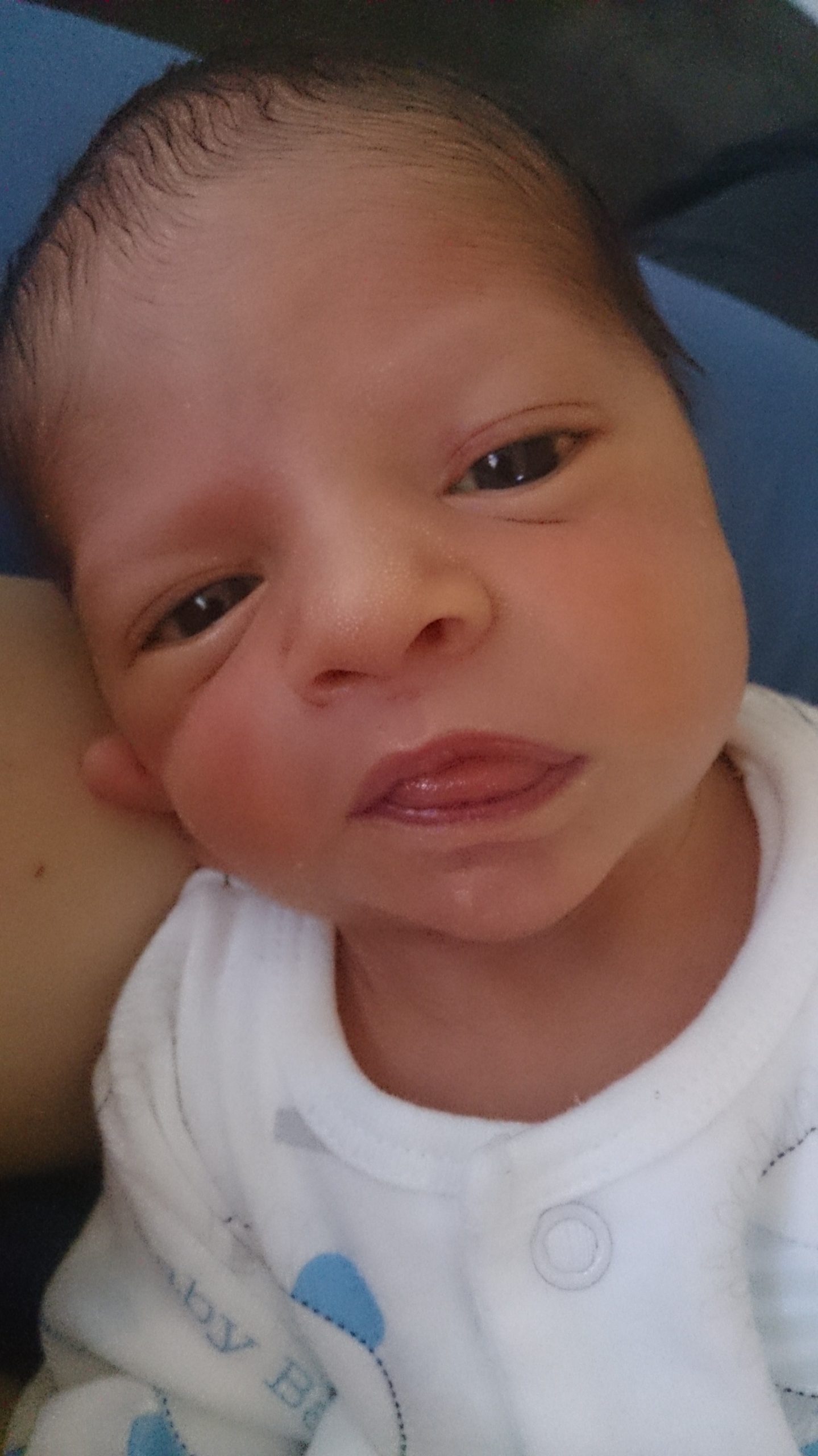 Baby with hemifacial microsomia