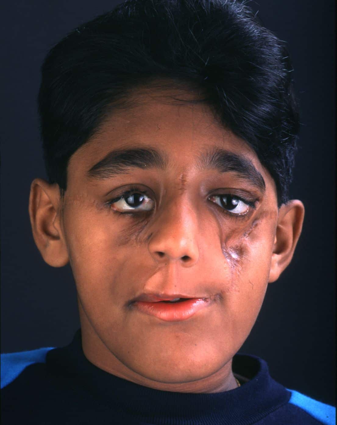 Boy with complex craniofacial cleft in process of multiple surgeries