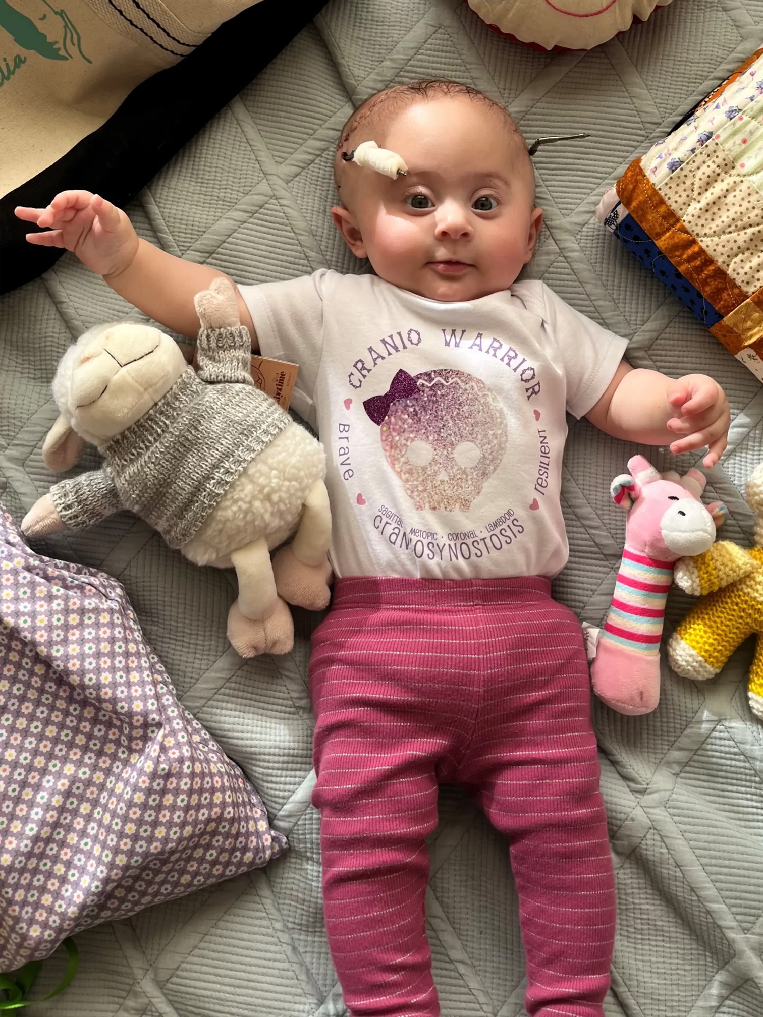 Baby with craniosynostosis surrounded by Craniofacial Australia care pack materials, wearing a Cranio Warrior t-shirt