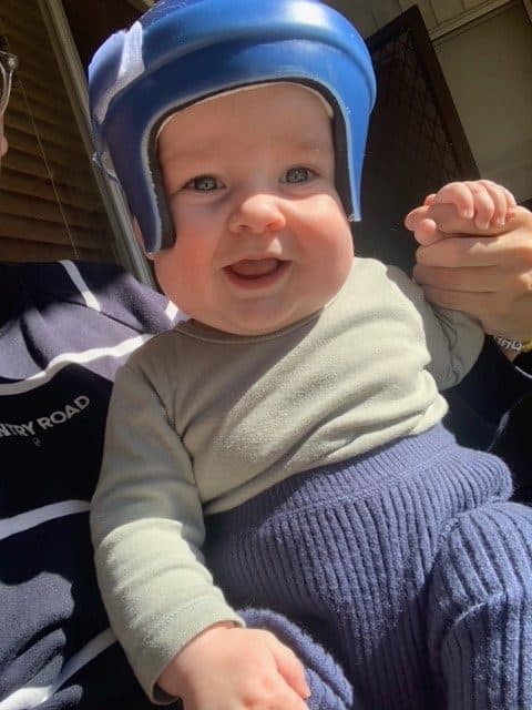Baby with sagittal synostosis wearing helmet following surgery