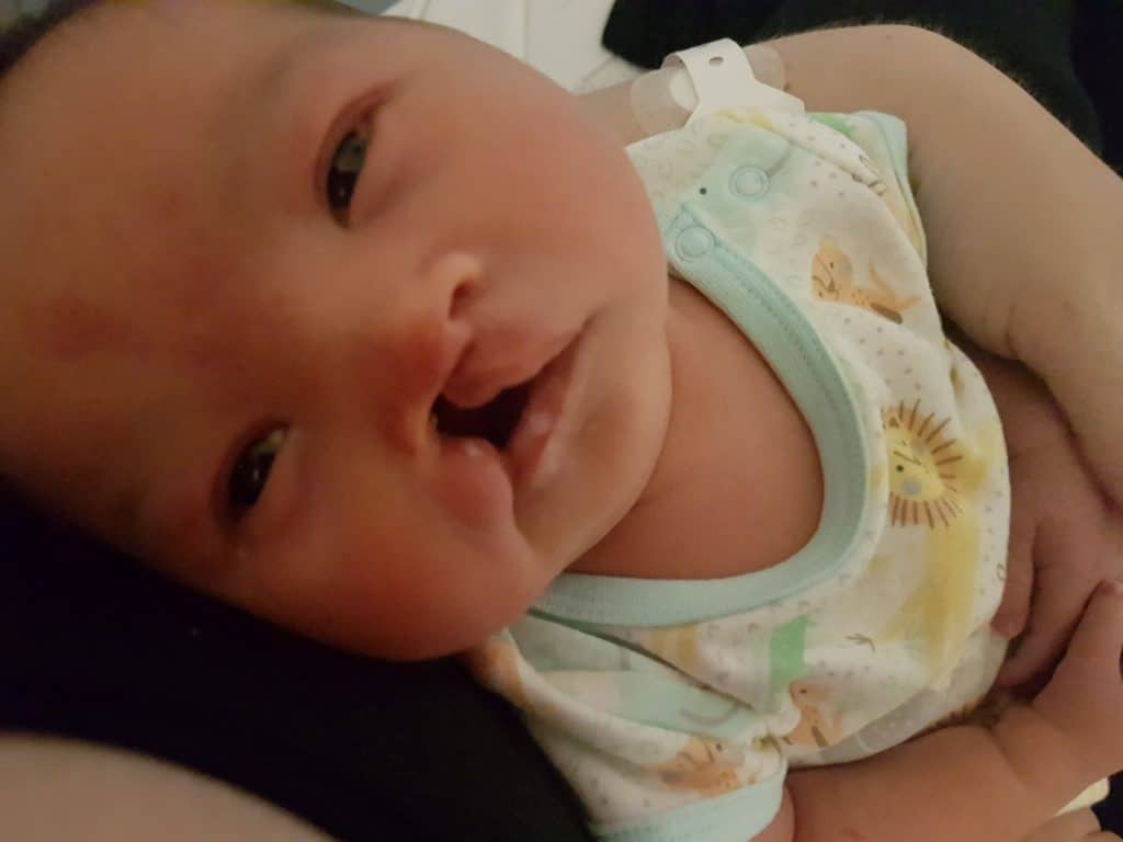 Baby with cleft lip and palate before surgery