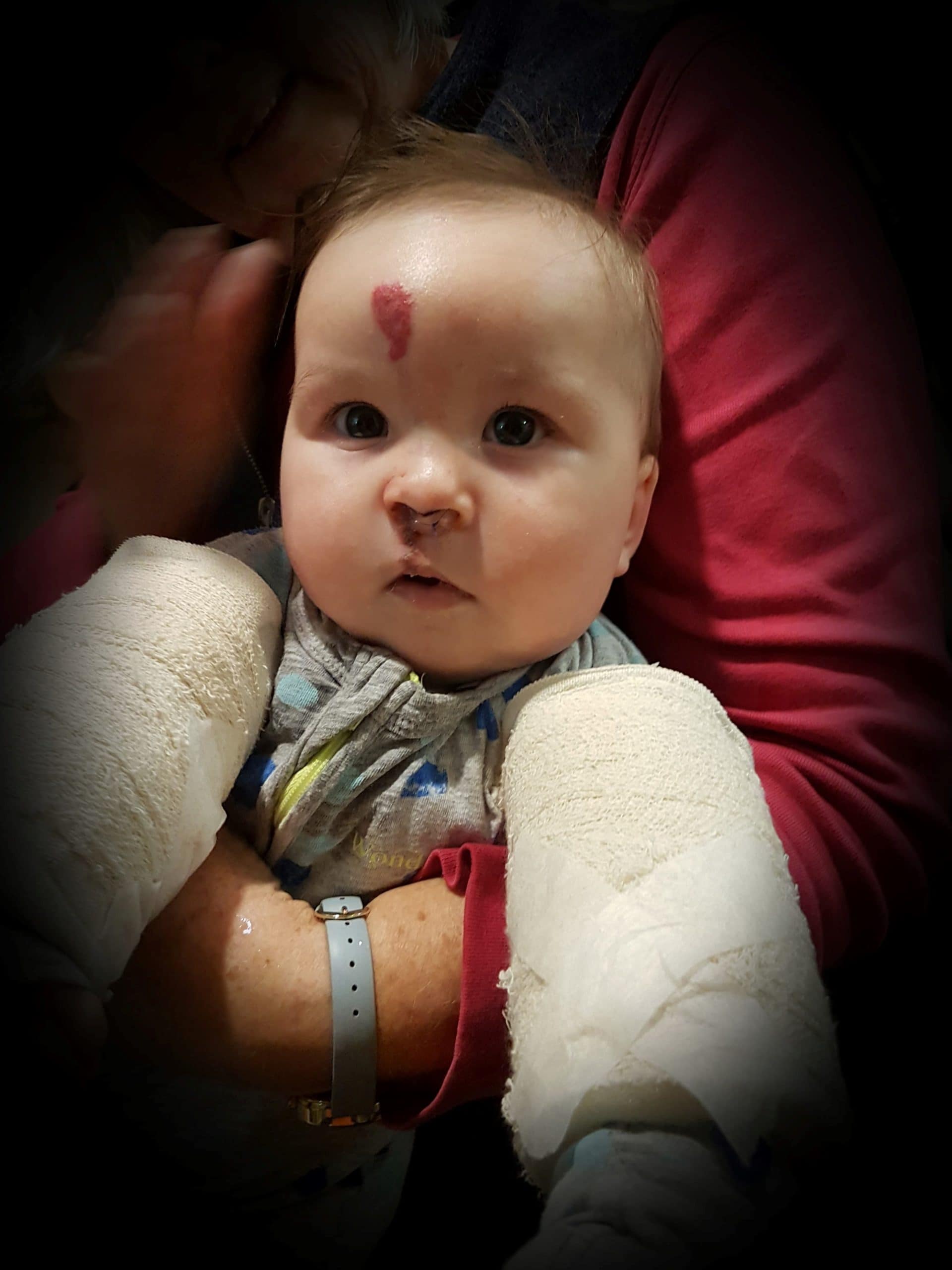 Baby with cleft lip and palate following initial surgery