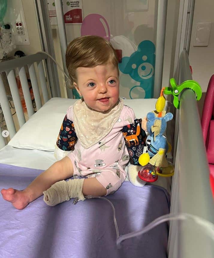Young child with Apert syndrome