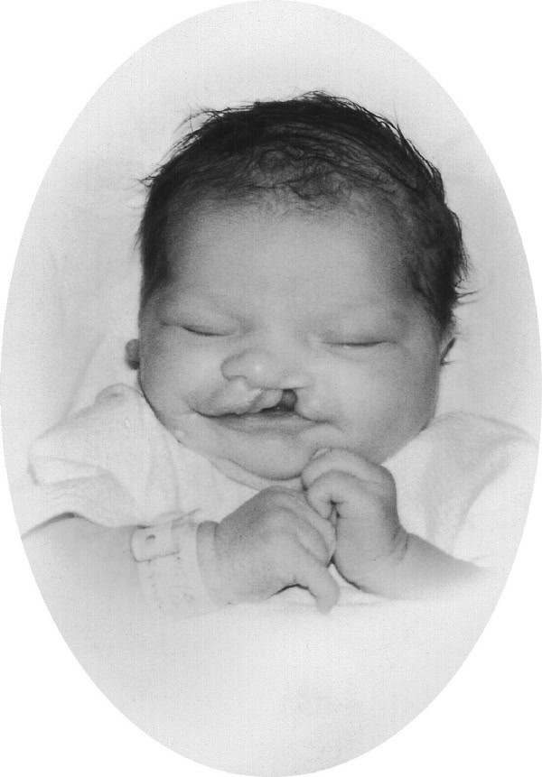 Baby with cleft lip and palate and Goldenhar syndrome