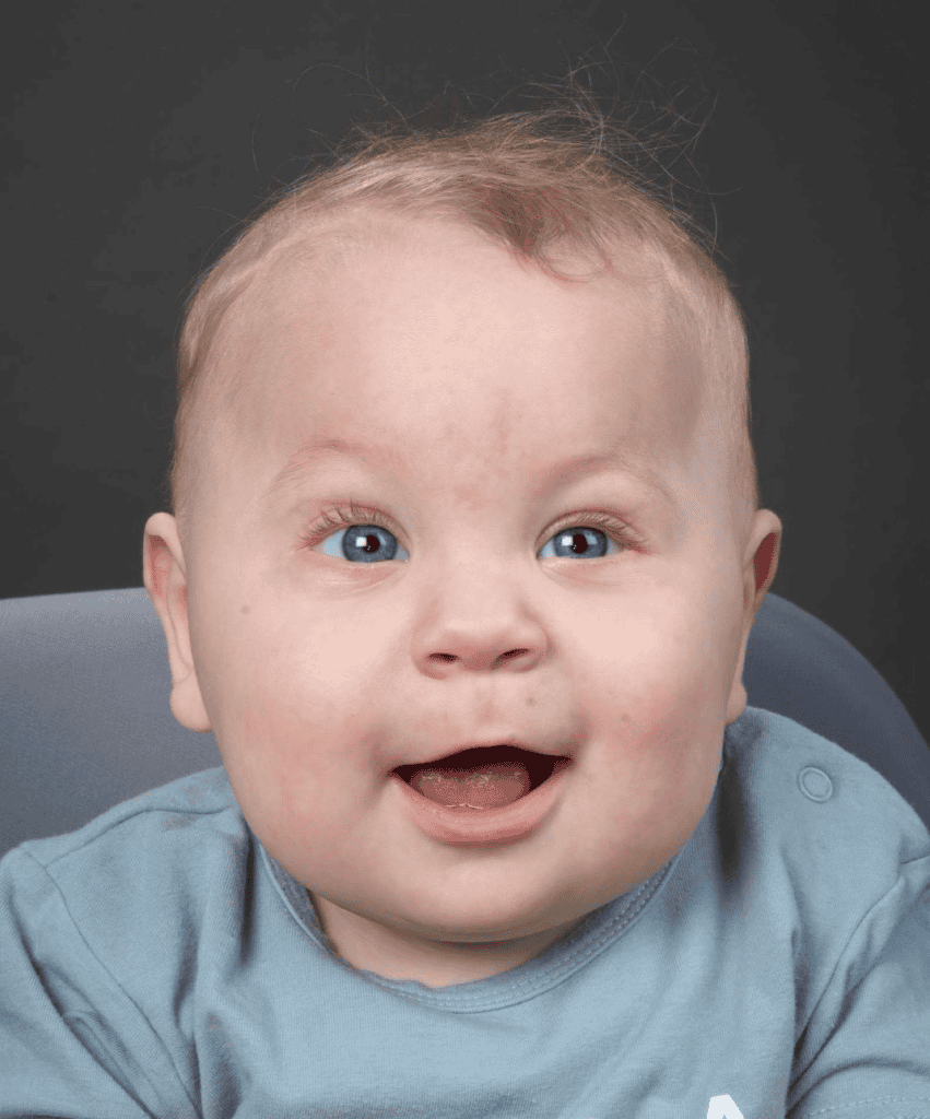 Baby with metopic synostosis and cystic fibrosis 