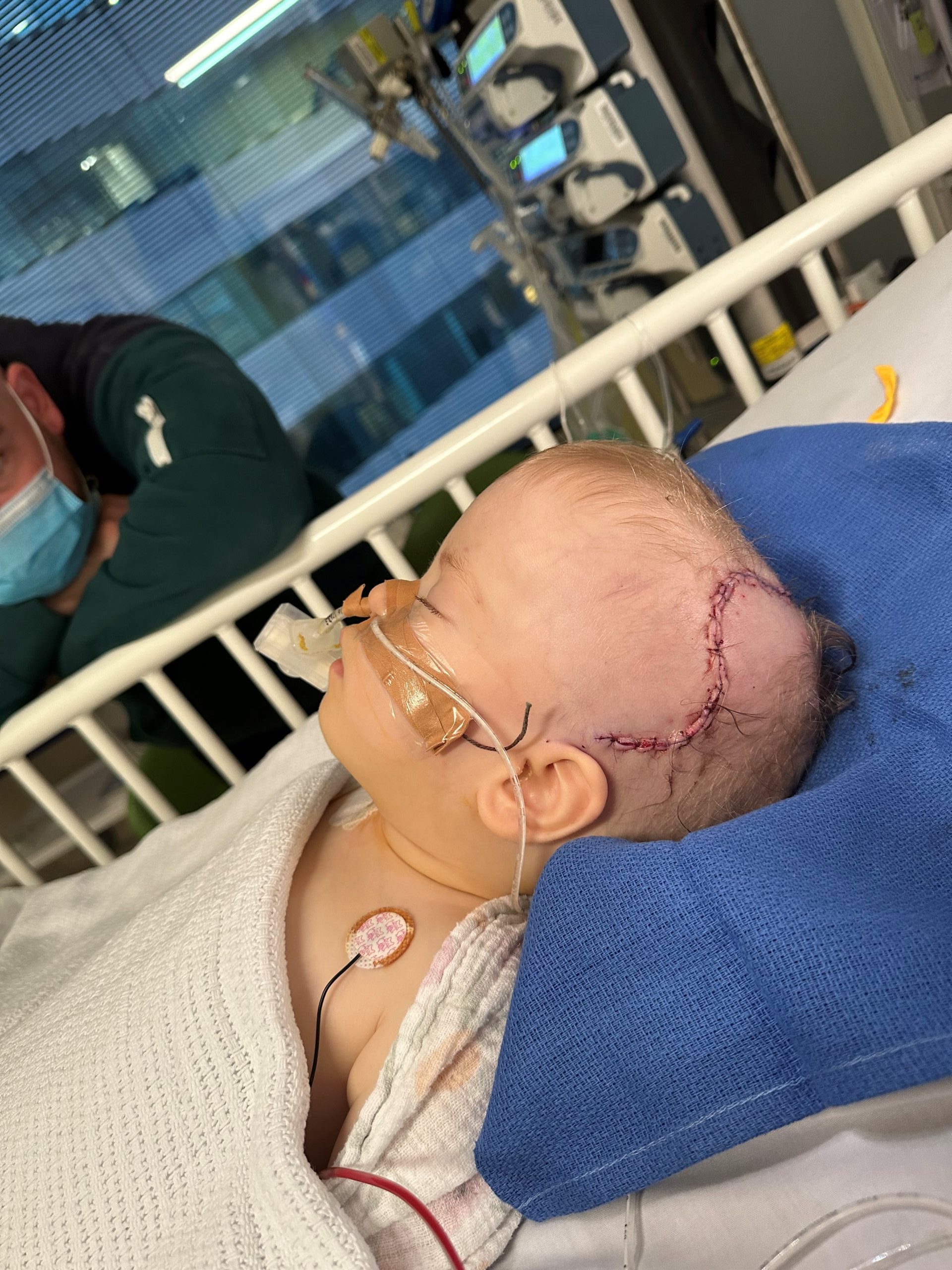 Baby girl with sagittal synostosis following craniofacial surgery, showing scars on head