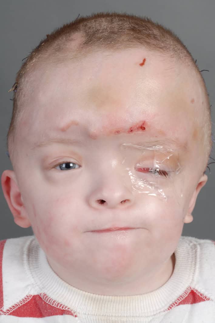 Boy with bicoronal synostosis showing stitches and clear tape over one eye