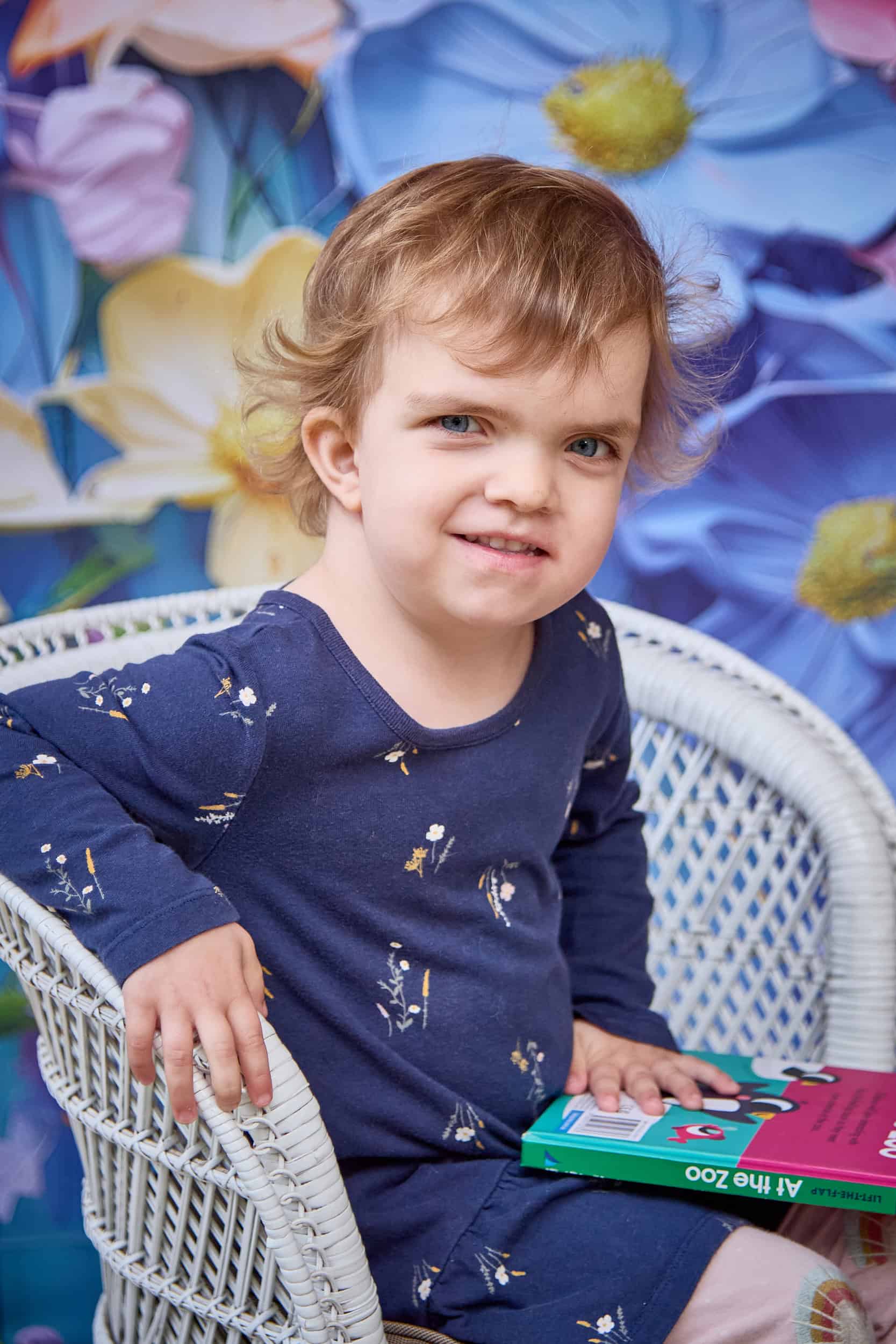 Little girl with Noonan syndrome and sagittal synostosis
