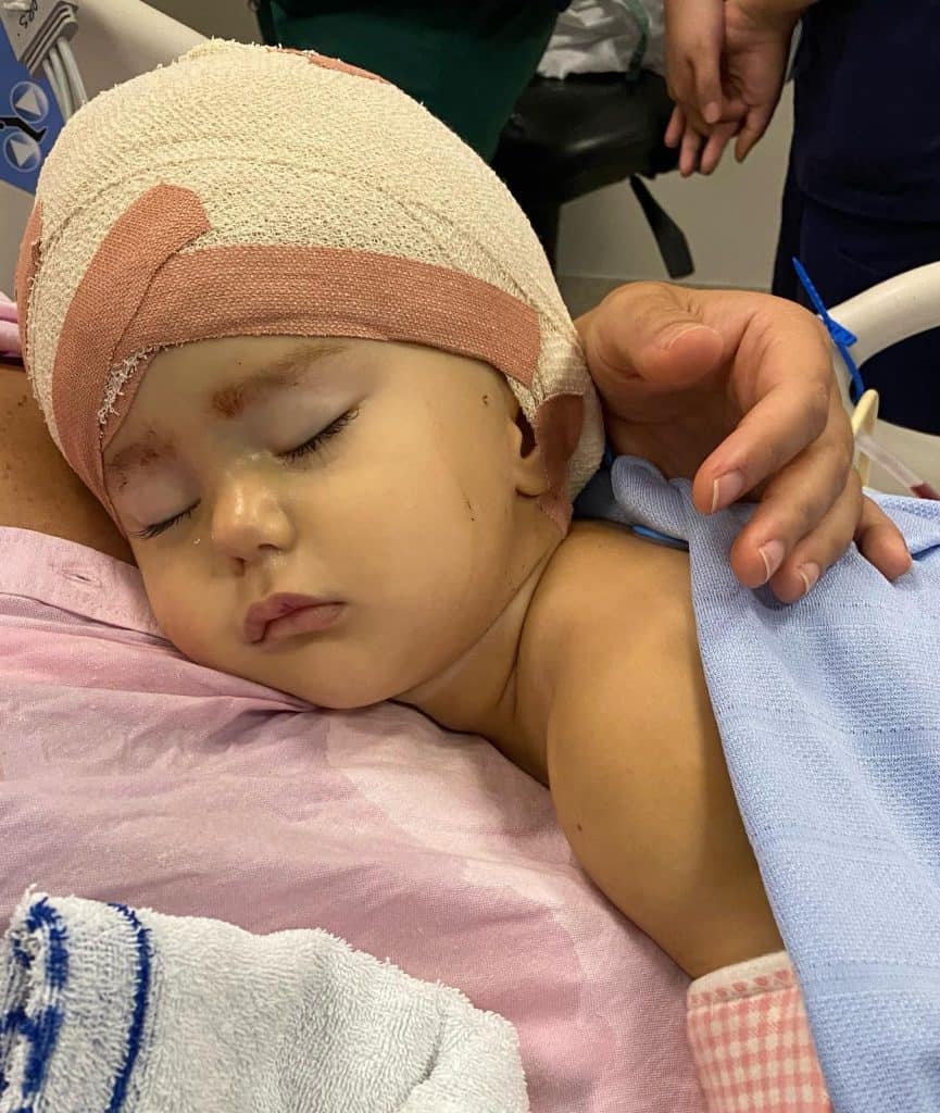 Girl with sagittal synostosis asleep, wearing a bandage on head following craniofacial surgery