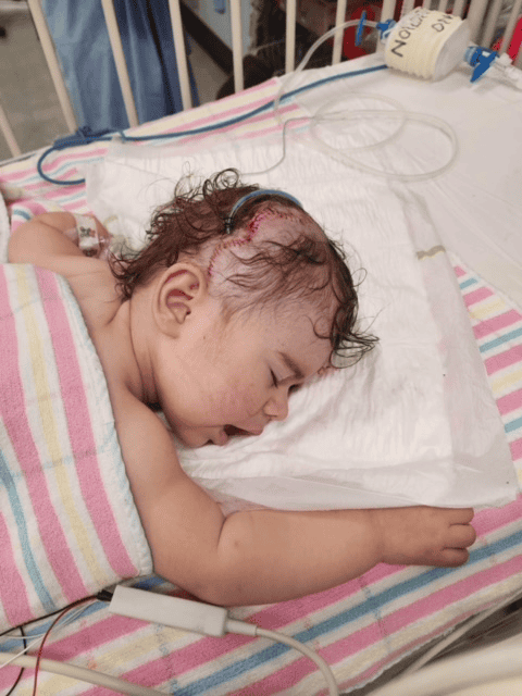Little girl with unicoronal synostosis and unilateral cleft lip resting after craniofacial surgery