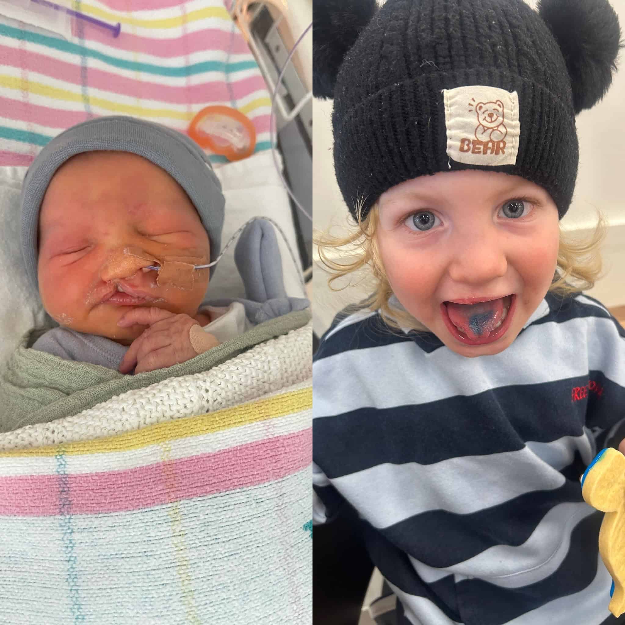 Before and after photos of boy with cleft lip and palate and metopic synostosis
