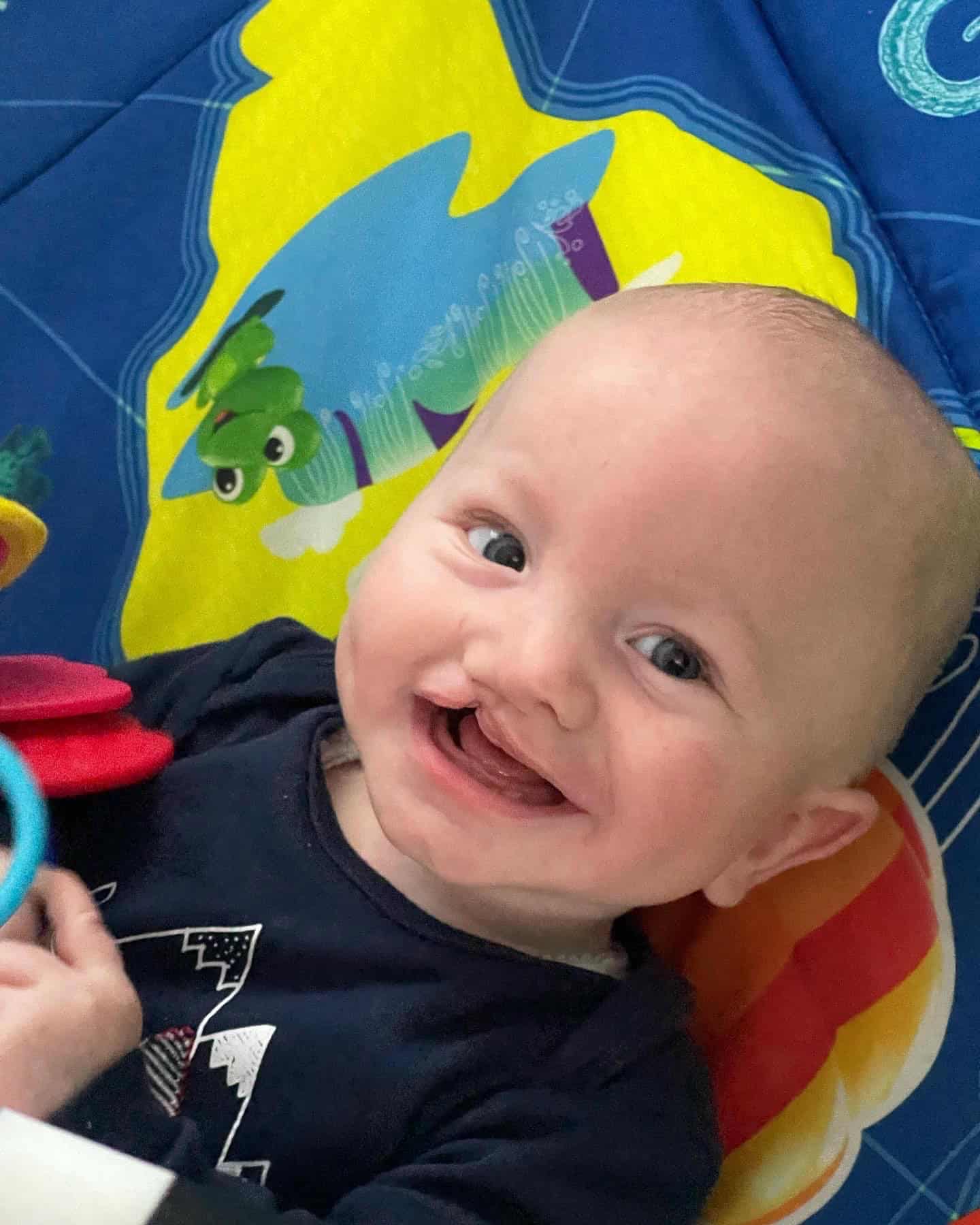 Baby with cleft lip and palate and metopic synostosis