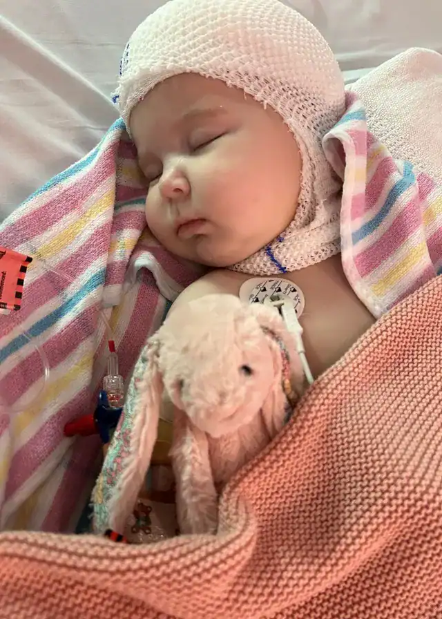 Baby with sagittal synostosis wearing head bandage after undergoing craniofacial surgery sleeping with a stuffed bunny.