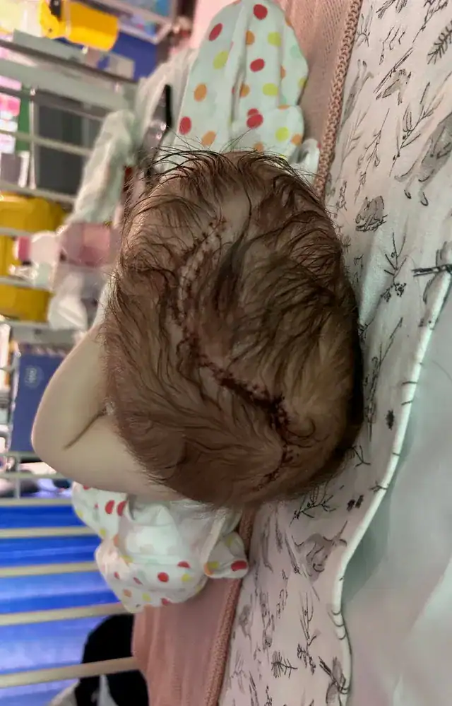 Baby with sagittal synostosis following surgery, showing stitches on top of head