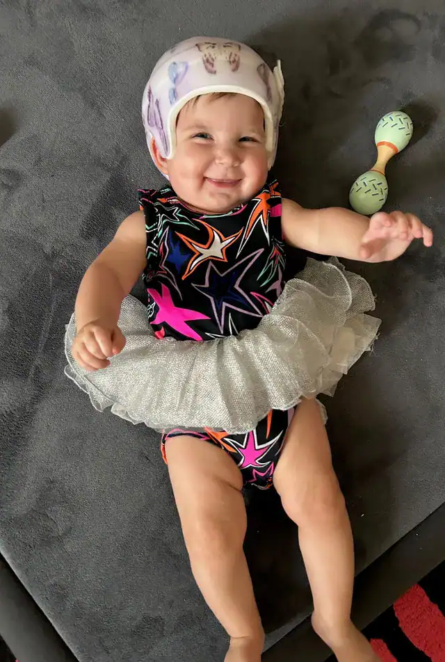 Baby with sagittal synostosis wearing helmet following surgery