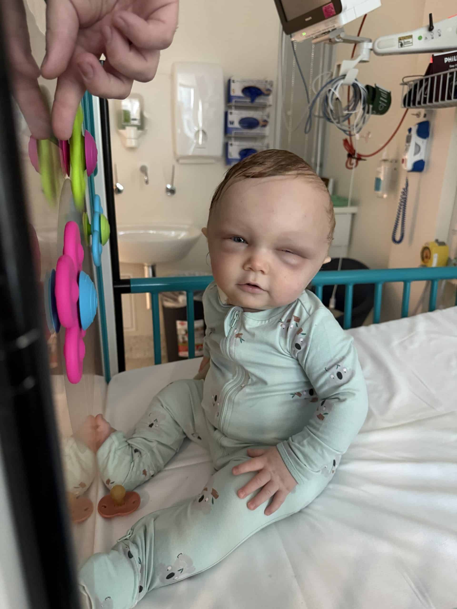 Baby with sagittal synostosis in hospital bed with medical equipment, with facial swelling following surgery.