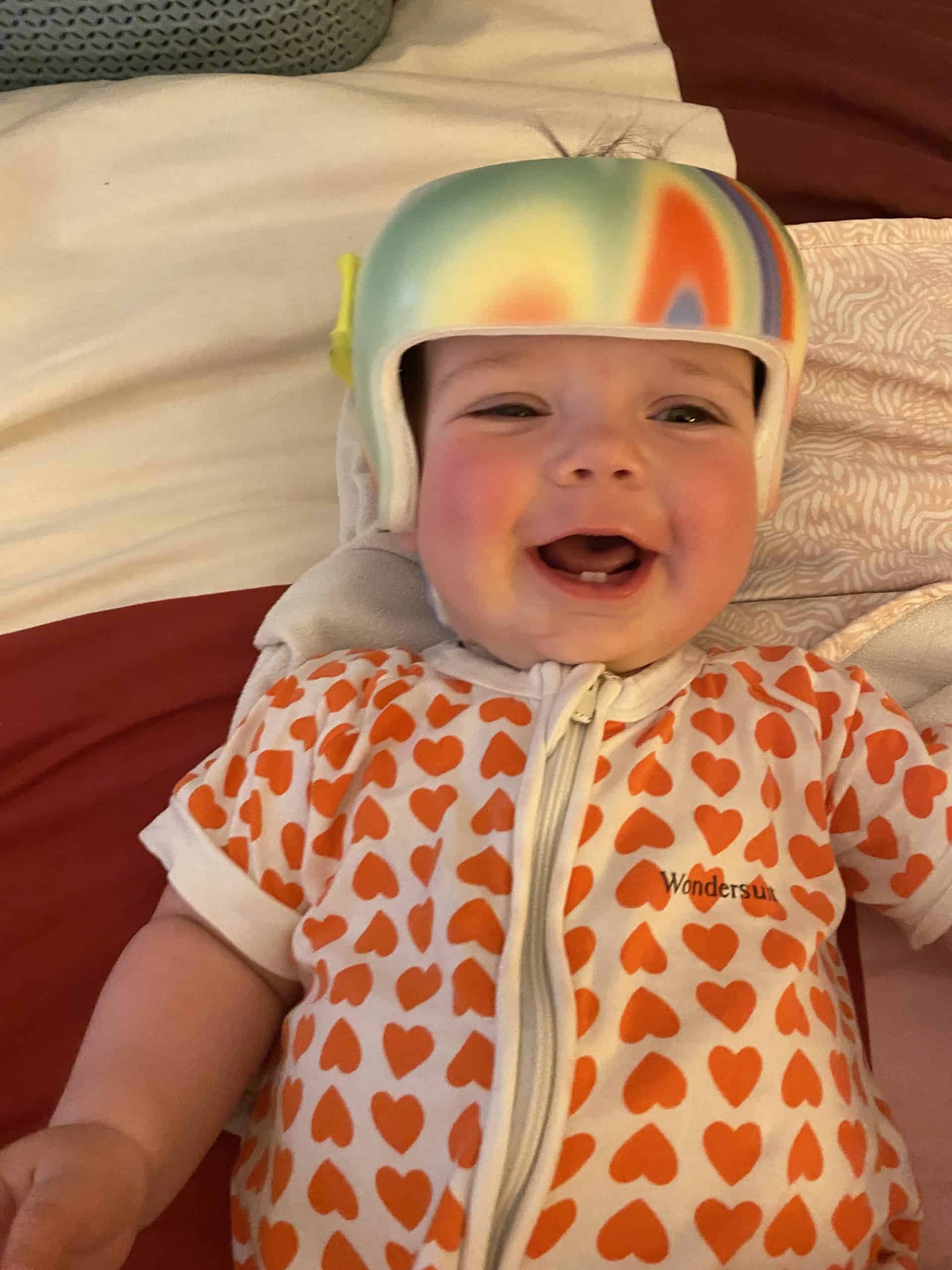 Baby boy with sagittal synostosis wearing helmet following craniofacial surgery