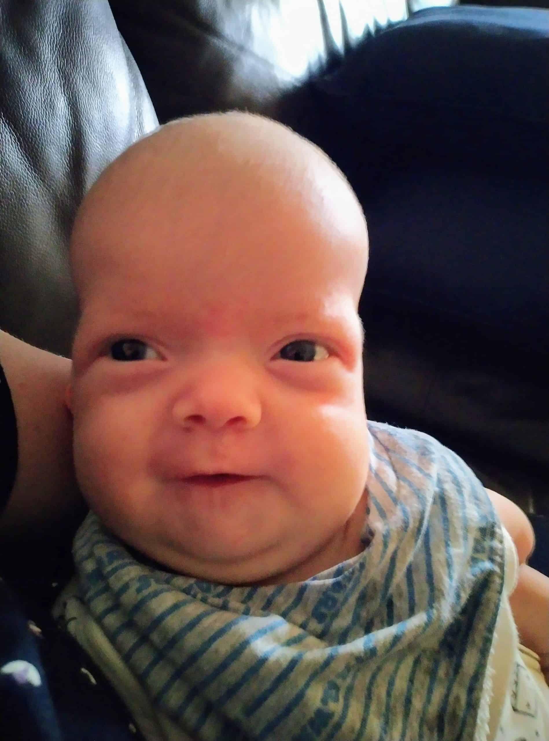 Baby girl with Noonan syndrome and sagittal synostosis before surgery