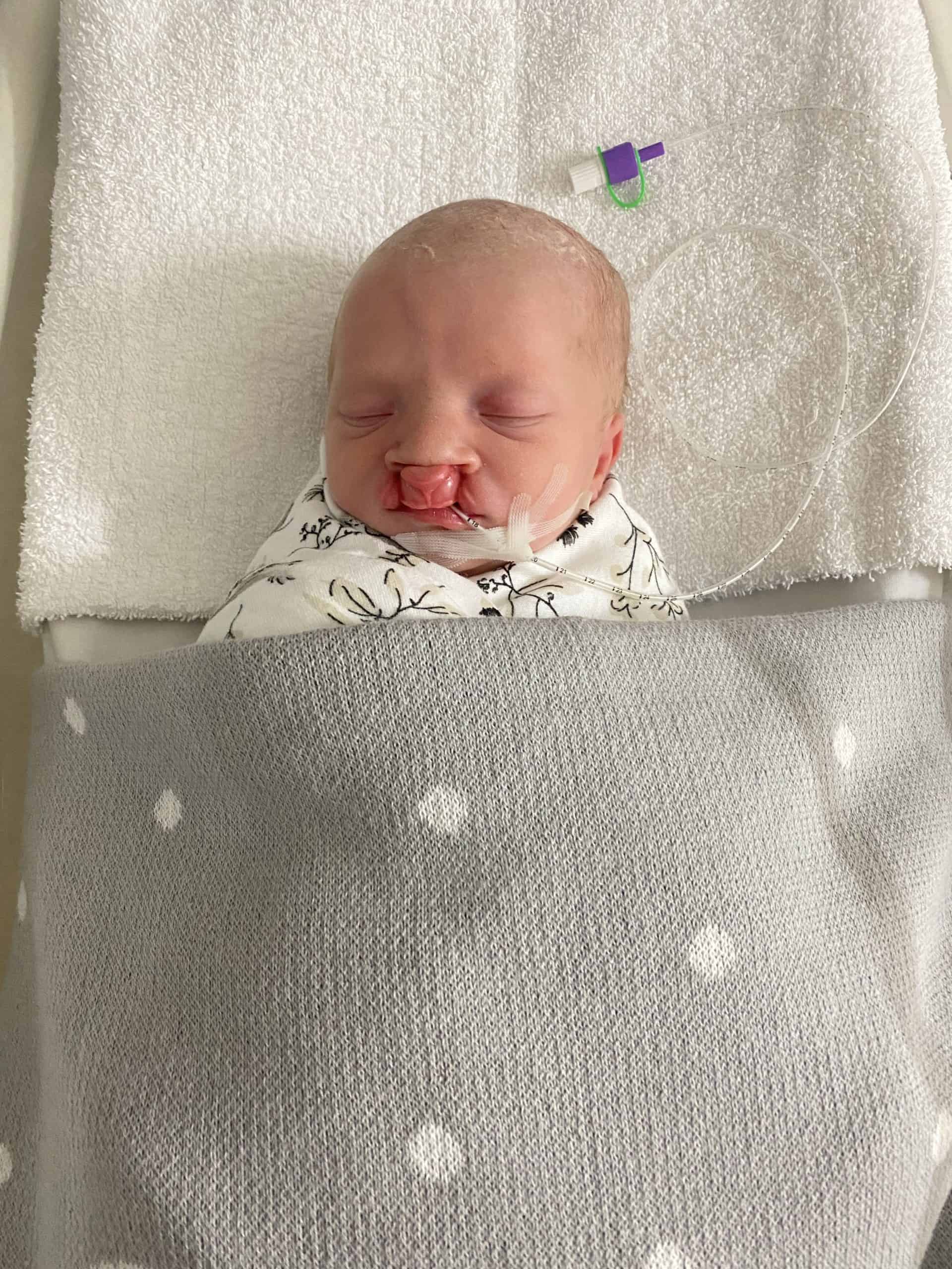 Baby with cleft lip and palate before surgery