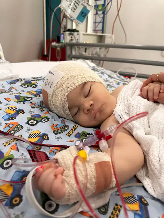 Baby boy with metopic synostosis with bandage on head, asleep and recovering after craniofacial surgery
