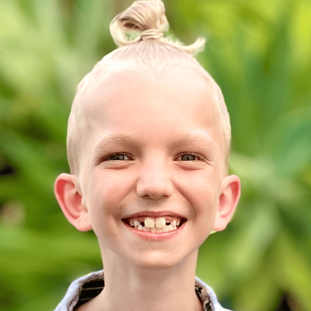 Boy with sagittal synostosis after surgery