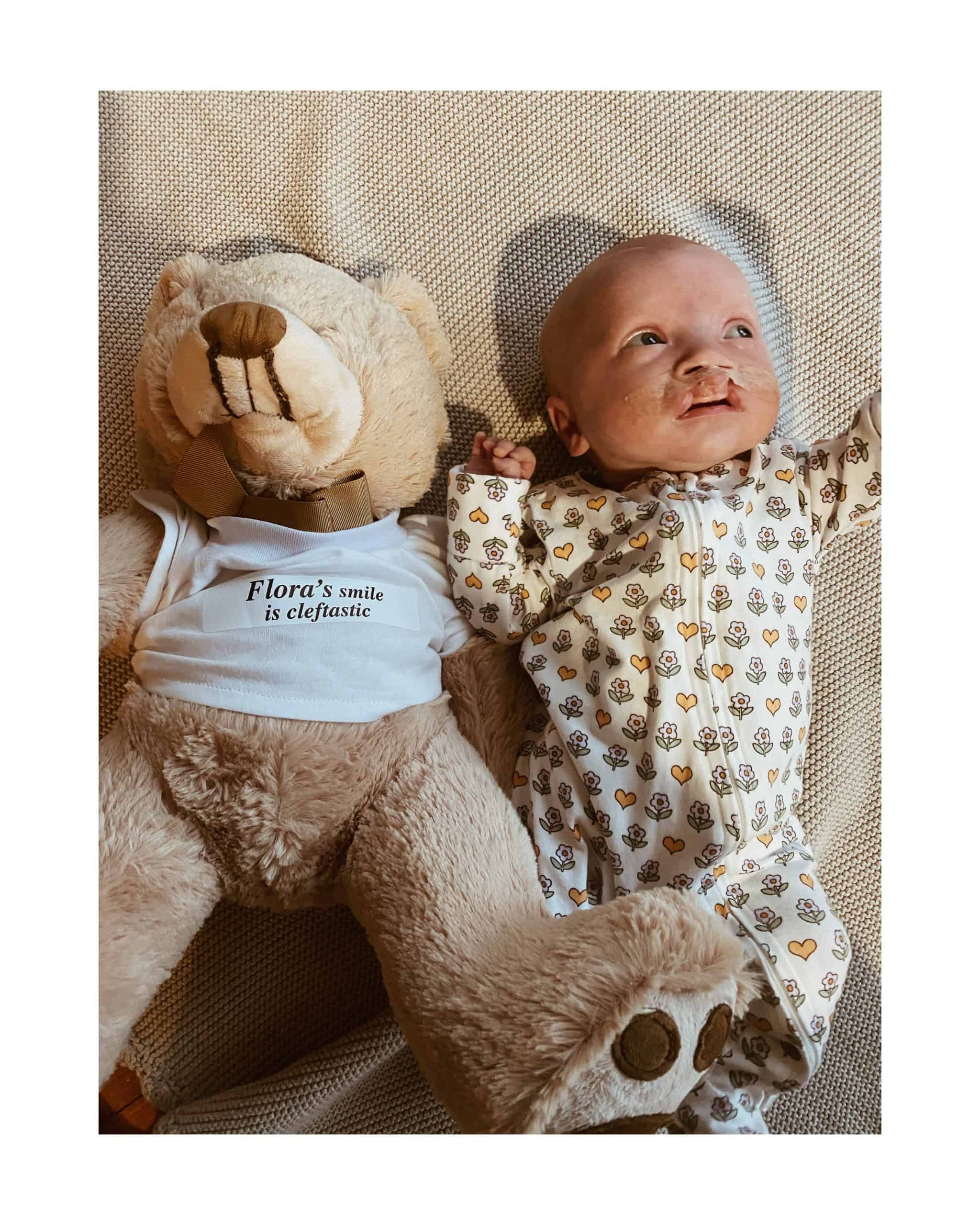 Baby with cleft lip and palate lying next to a teddy bear