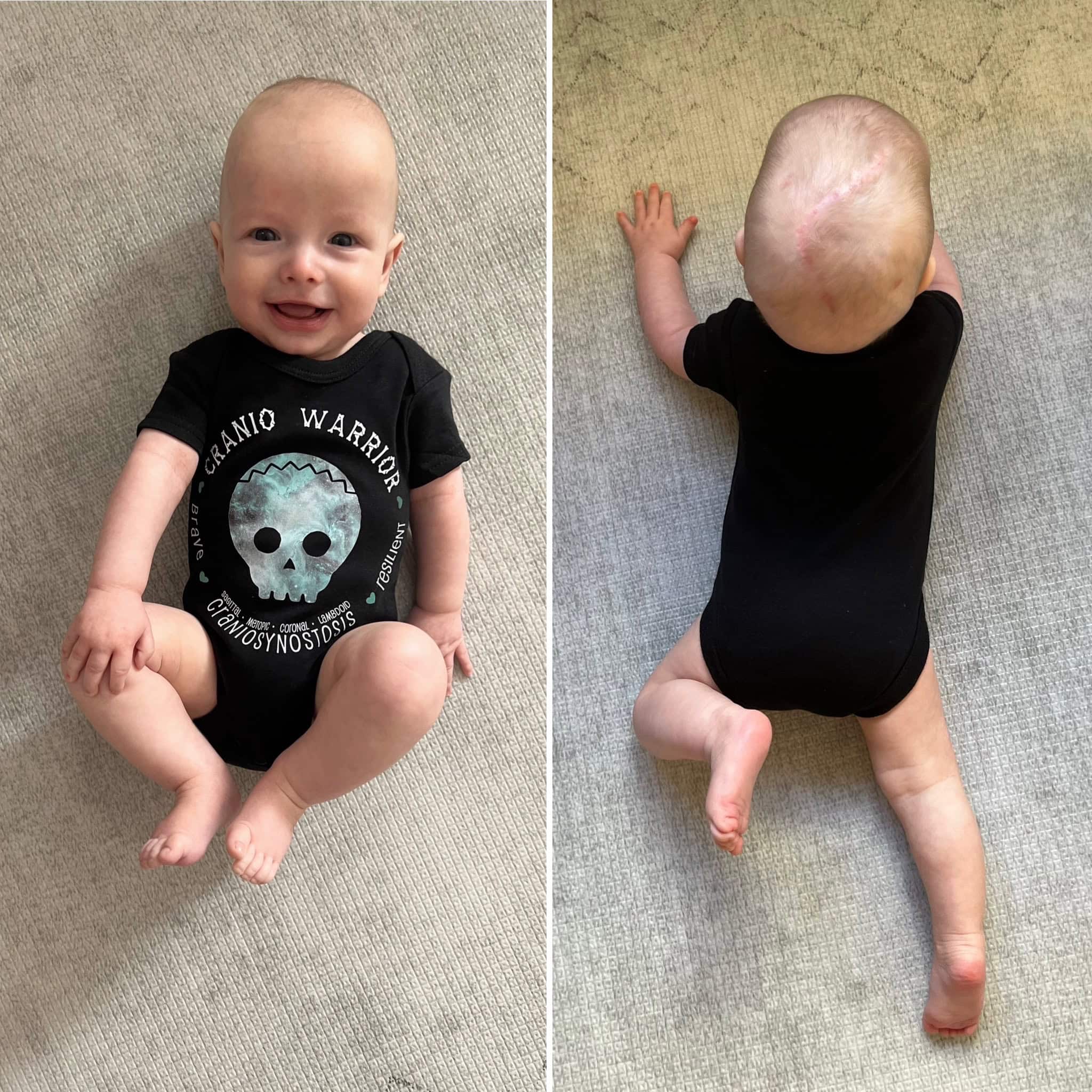 Two photos of baby boy with sagittal synostosis lying on floor wearing Cranio Warrior t-shirt