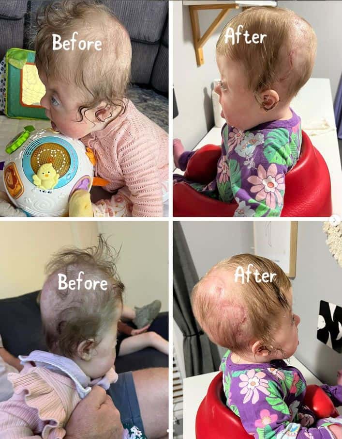 Four photos of little girl with Apert syndrome showing progress of surgical treatment on head