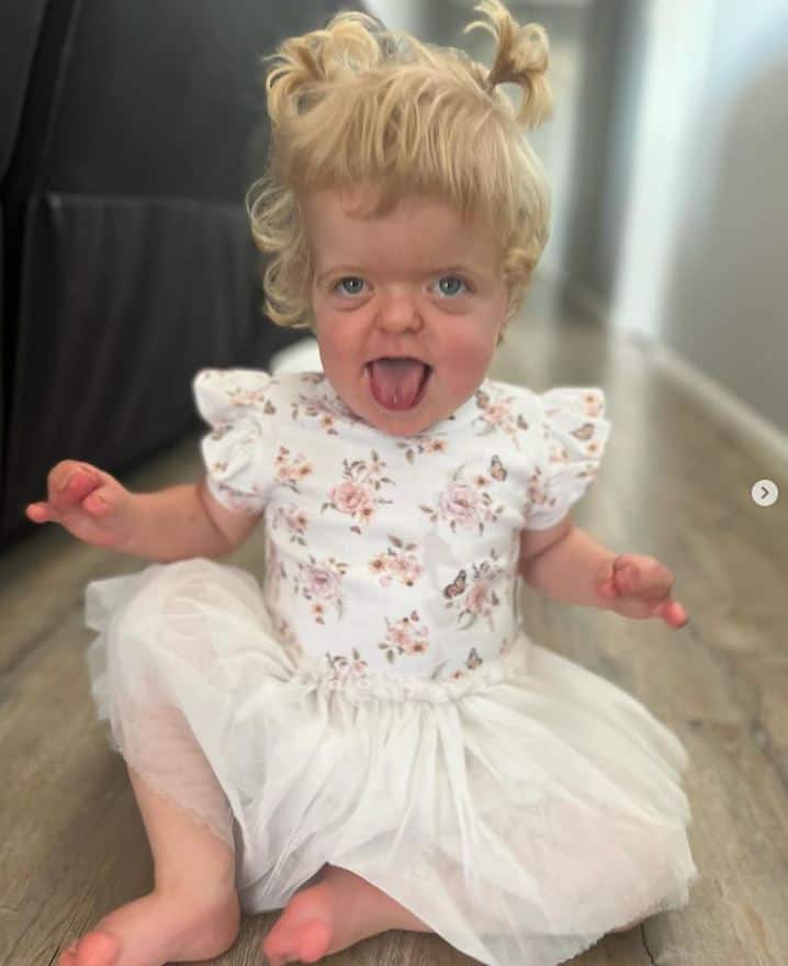 Little girl with Apert syndrome