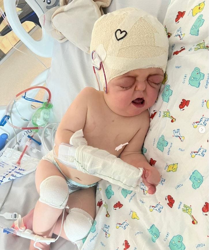 Baby girl with Apert syndrome wearing helmet following craniofacial survery and bandages on arm, lying in hospital cot