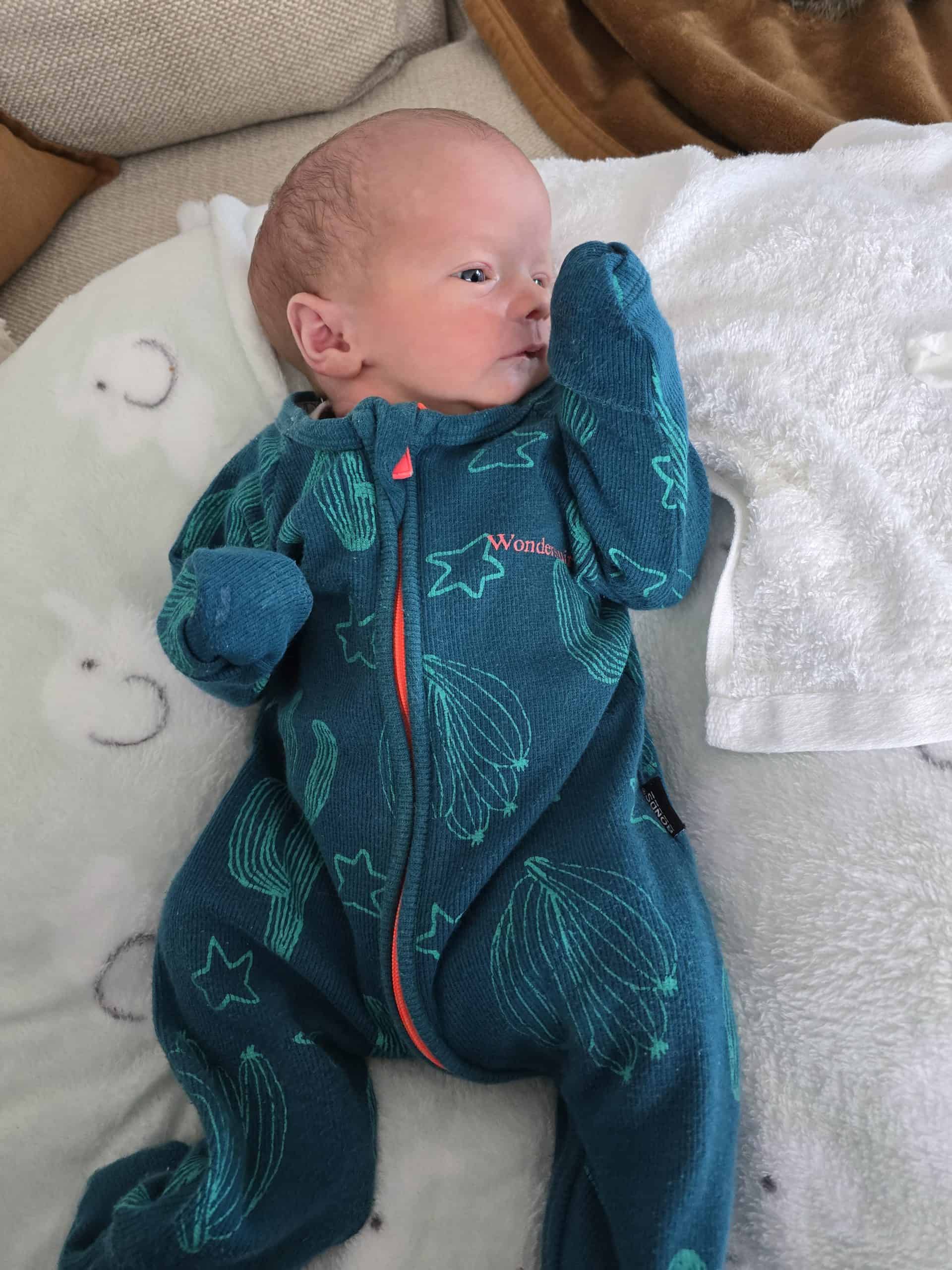 Baby with sagittal synostosis in blue onesie lying on a bed with white blanket.