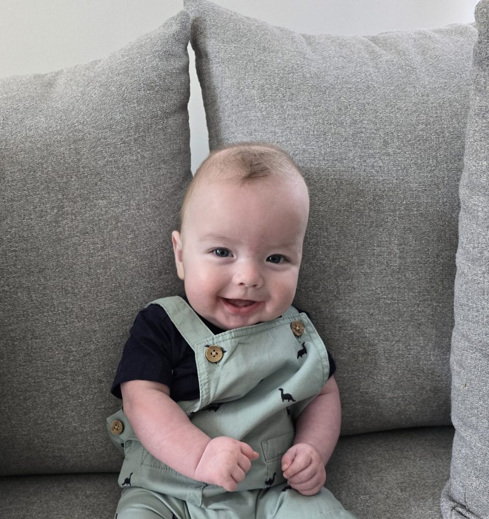Baby with sagittal synostosis after undergoing helmet therapy, sitting on a sofa.