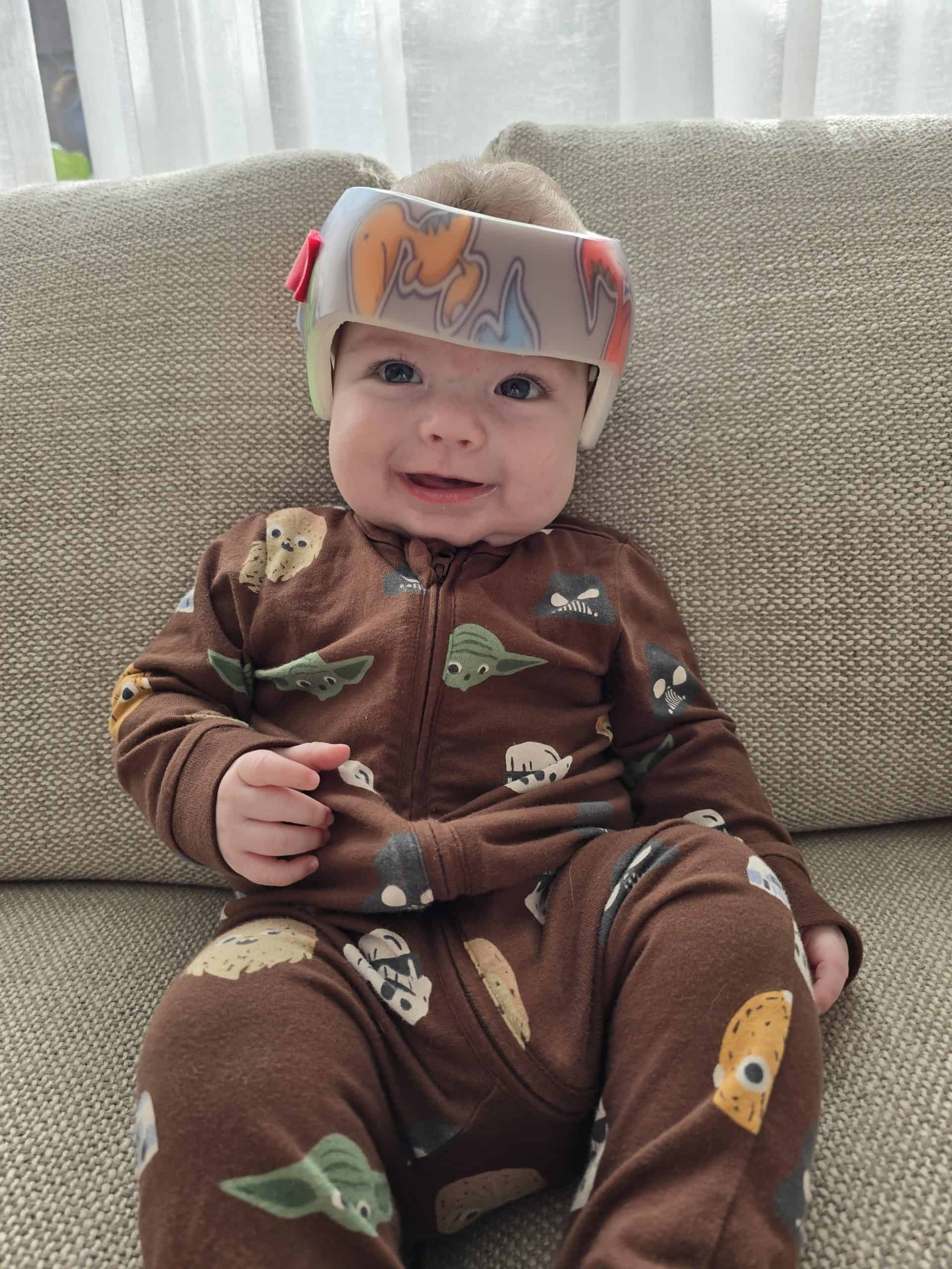Baby wearing a helmet, after undergoing craniofacial surgery for sagittal synostosis, sitting on a sofa, smiling.