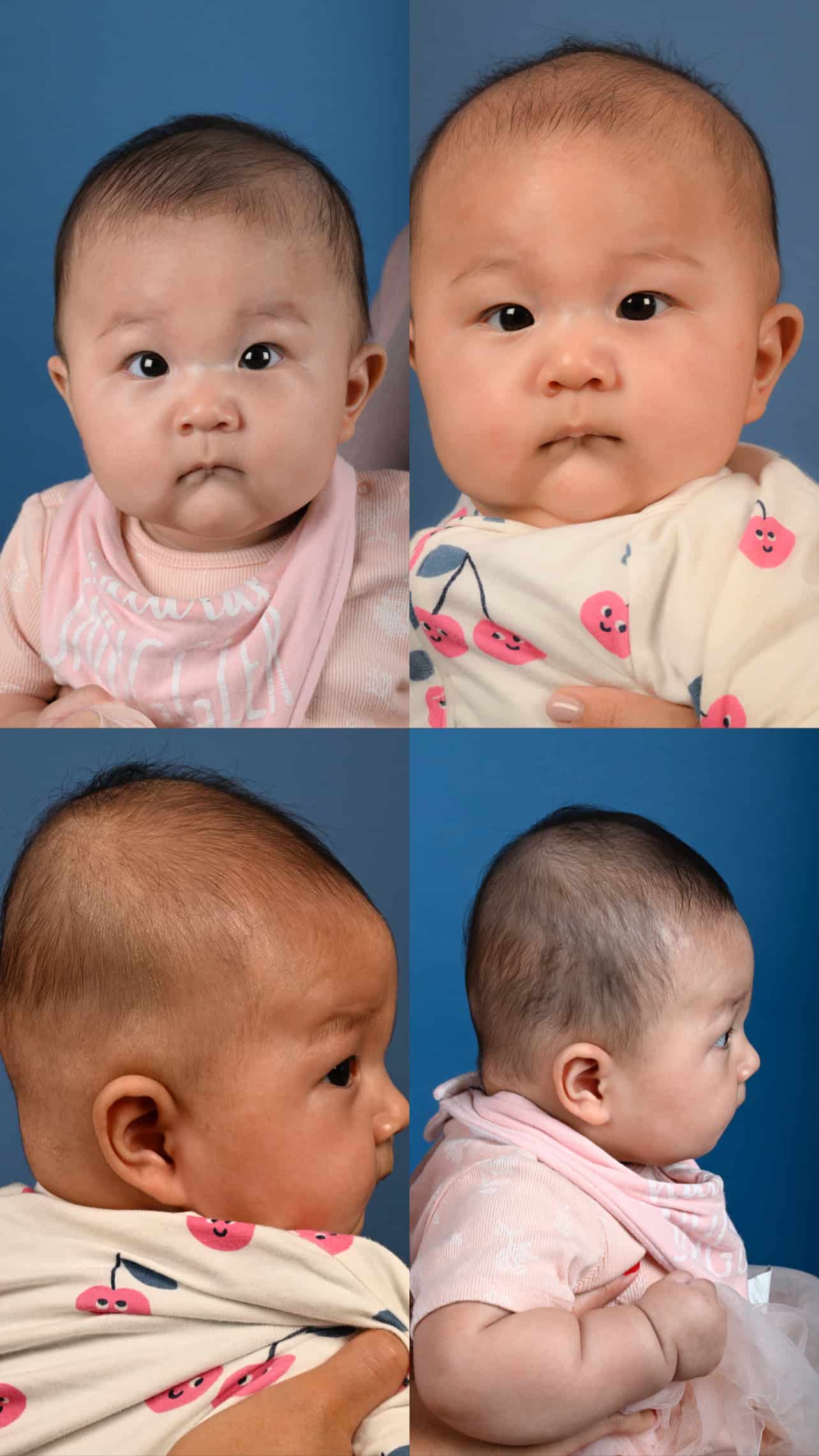 Before and after photos of baby with metopic synostosis