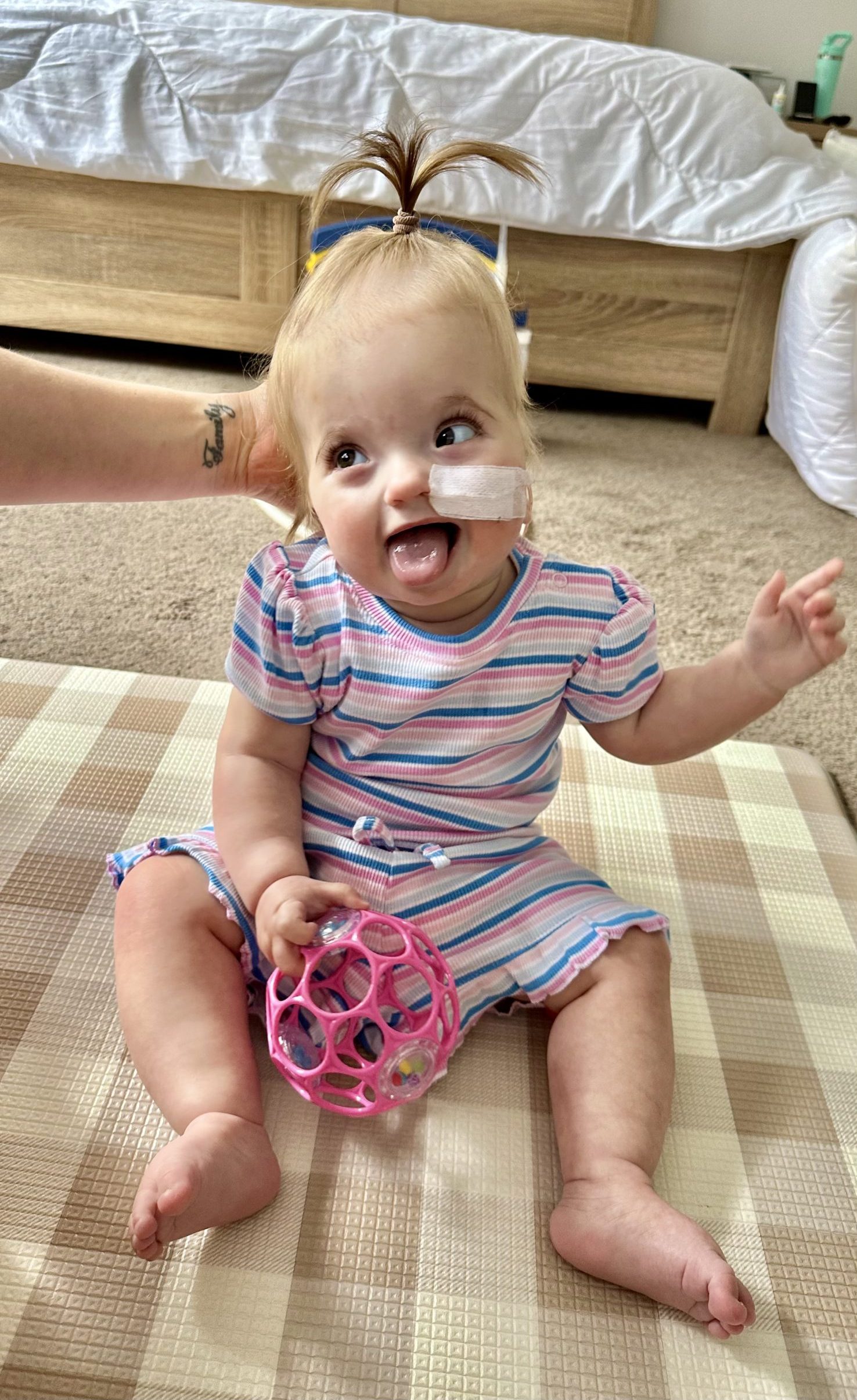 Toddler with lambdoid synostosis with bandage on face