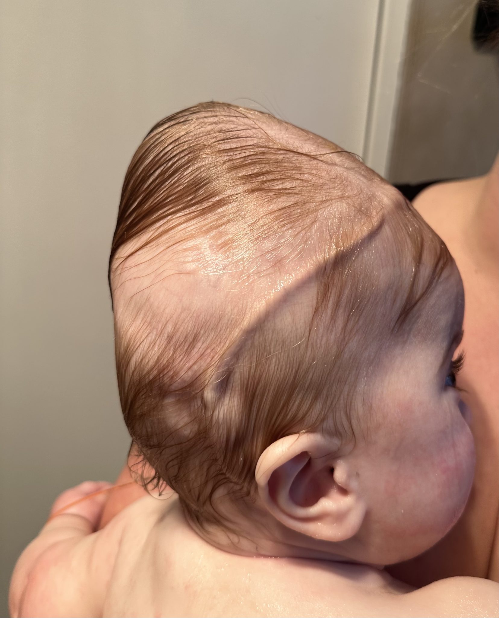 Profile view of baby with lambdoid synostosis