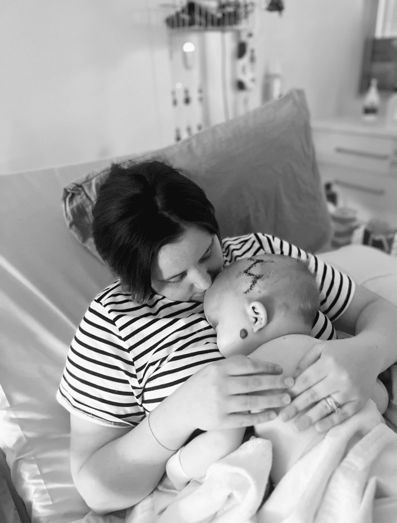 Baby with sagittal synostosis held by her mother in a hospital bed shortly after surgery, showing stitches on cranium.
