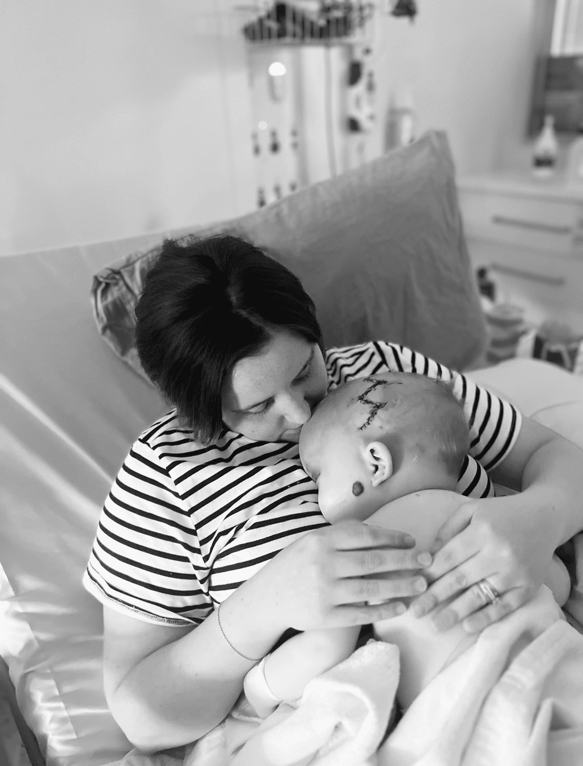 Baby with sagittal synostosis held by her mother in a hospital bed shortly after surgery, showing stitches on cranium.