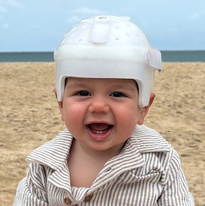Baby with sagittal synostosis wearing helmet following surgery, on the beach.