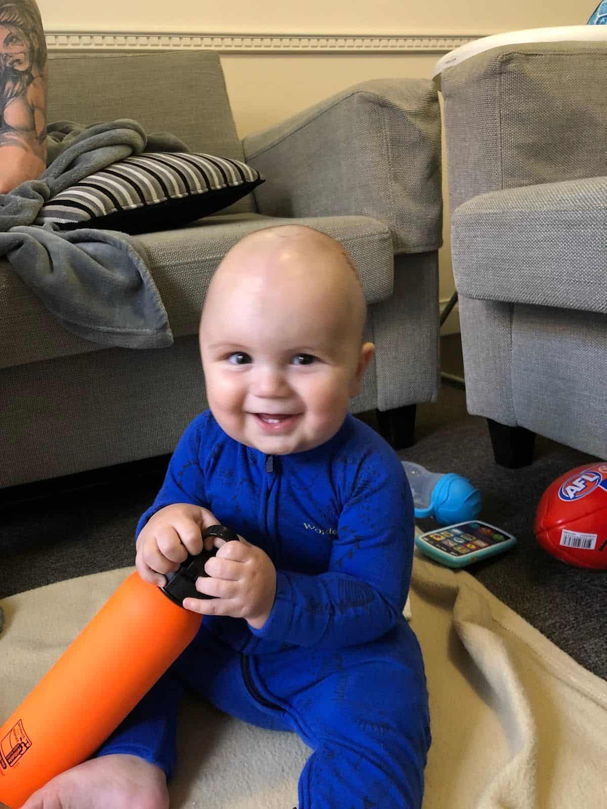 Baby with sagittal synostosis, post-surgery