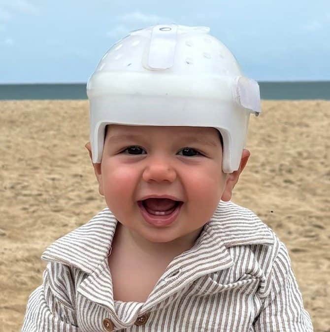 Smiling toddler on the beach, wearing a helmet after undergoing craniofacial surgery for sagittal synostosis.
