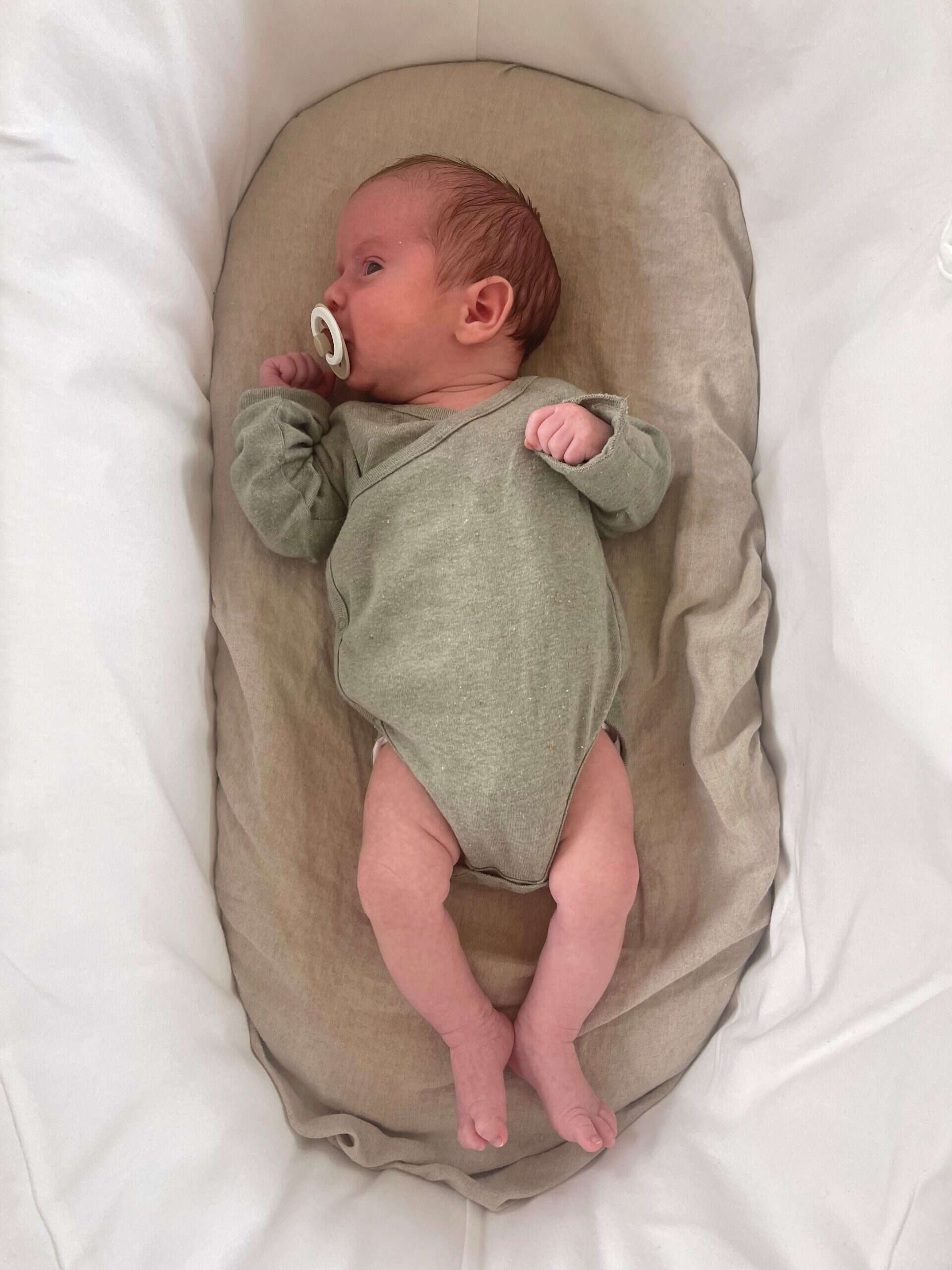 Baby with sagittal synostosis lying in hospital bassinet, pacifier in mouth.