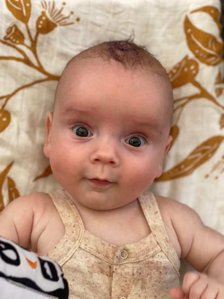 Baby with sagittal synostosis.