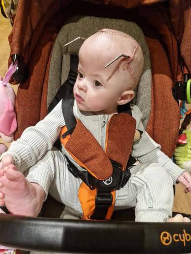 Young child with cranial surgery scars in a stroller, looking to the side.